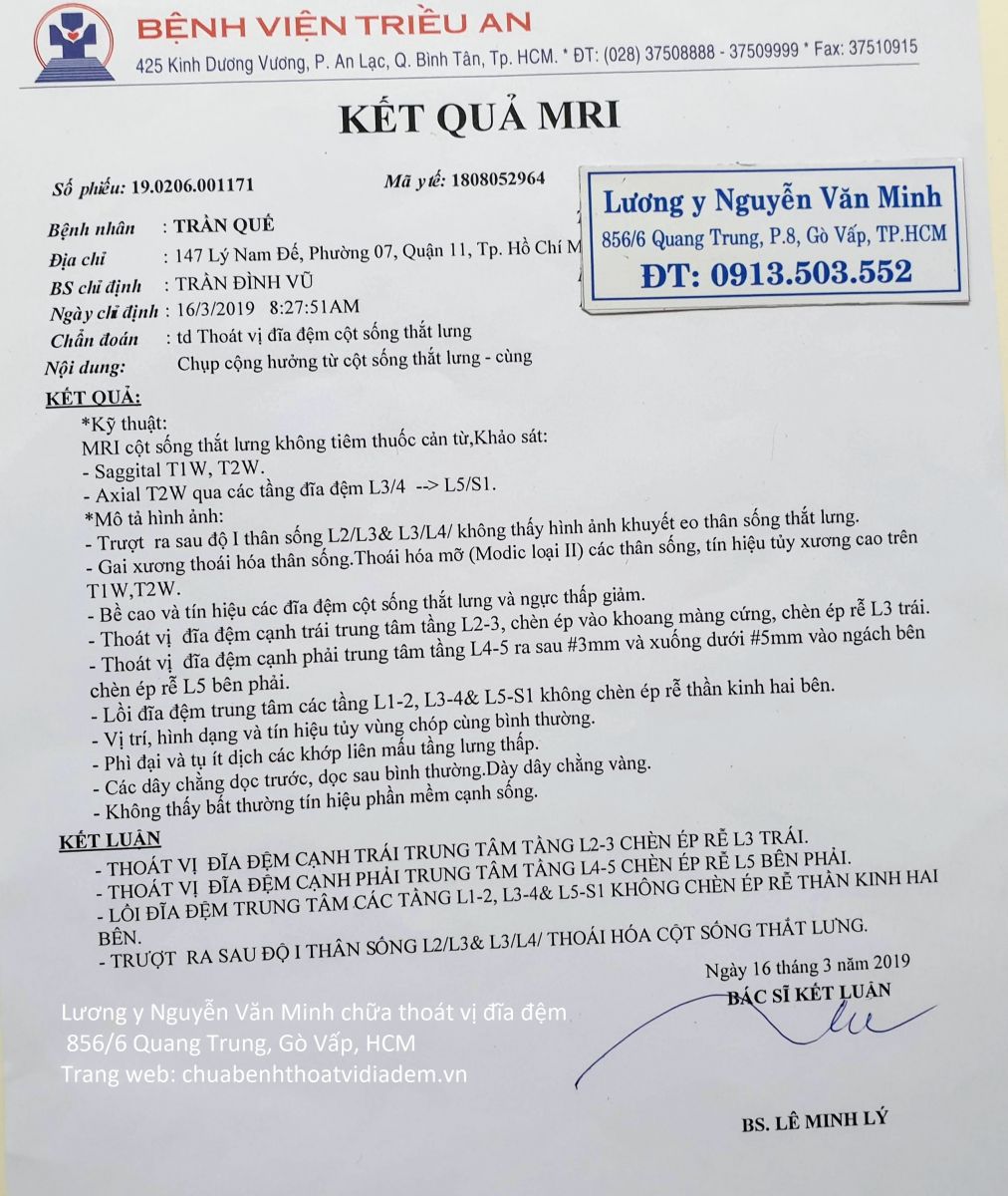 Thoát vị đĩa đệm chèn ép rễ thần kinh